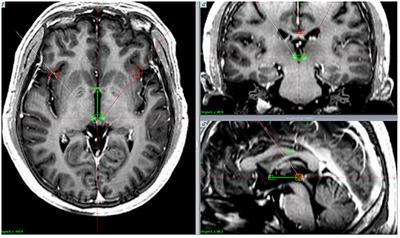 Deep Brain Stimulation-Induced Transient Effects in the Habenula